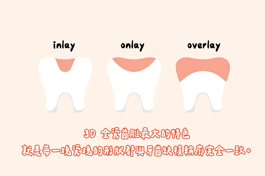 inlay onlay overlay 東嶼齒雕圖片