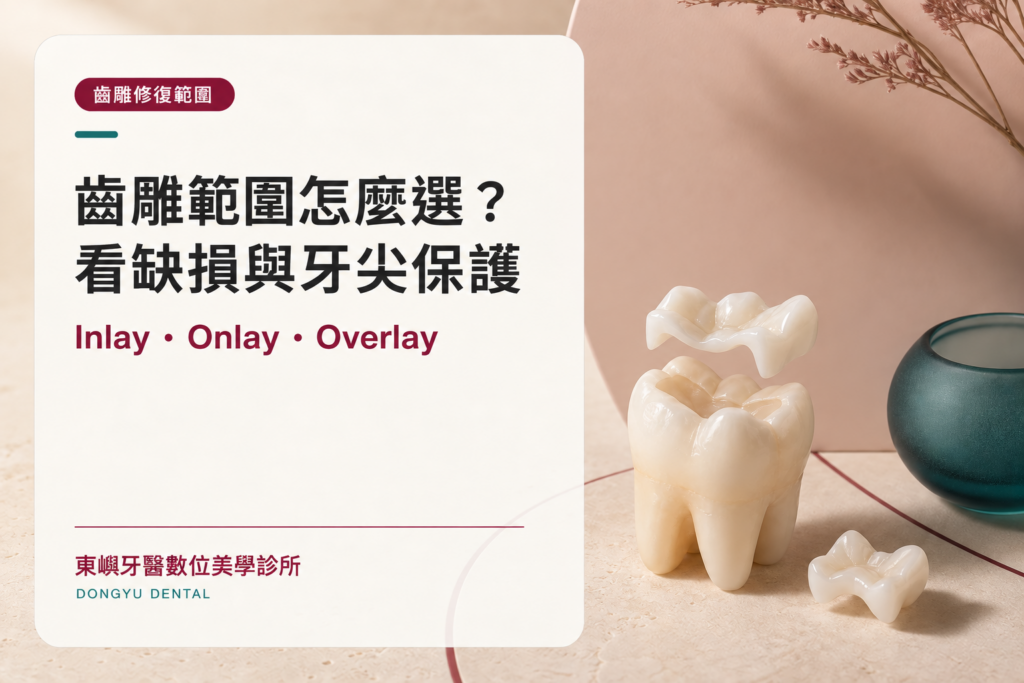 齒雕範圍怎麼選？看缺損與牙尖保護：Inlay、Onlay、Overlay