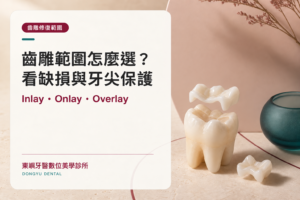 齒雕範圍怎麼選？看缺損與牙尖保護：Inlay、Onlay、Overlay