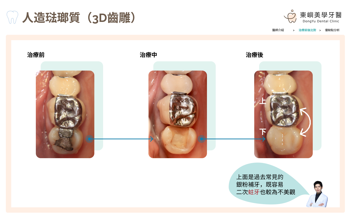 人造琺瑯質後牙照片比對
