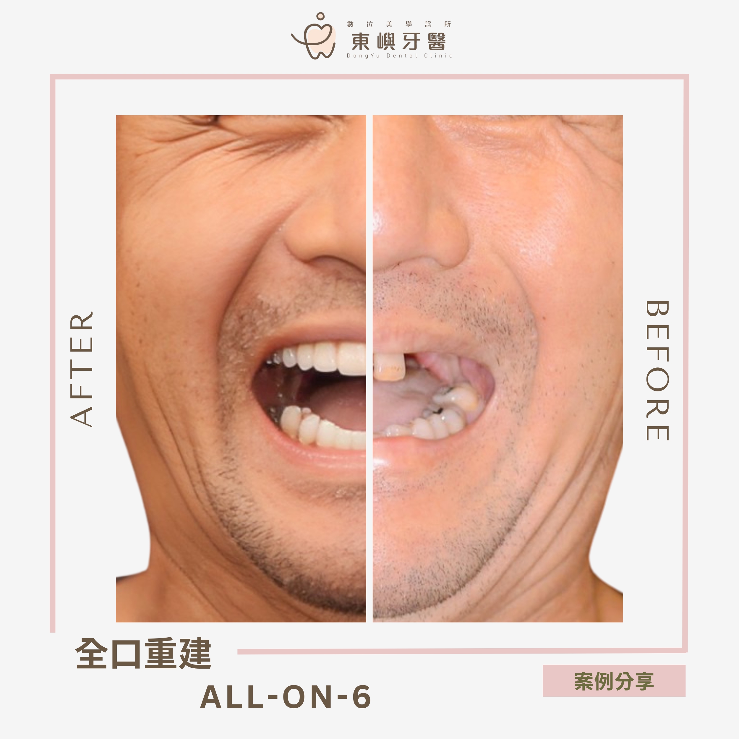 All-on-6 全口重建治療前後對照案例