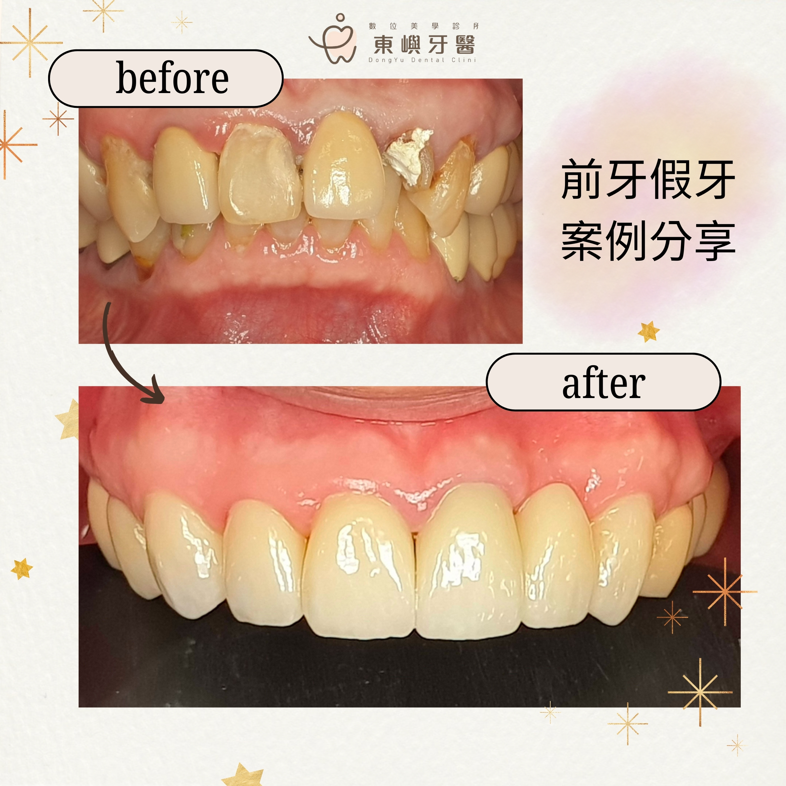 東嶼牙醫前牙假牙案例與顏色形態評估