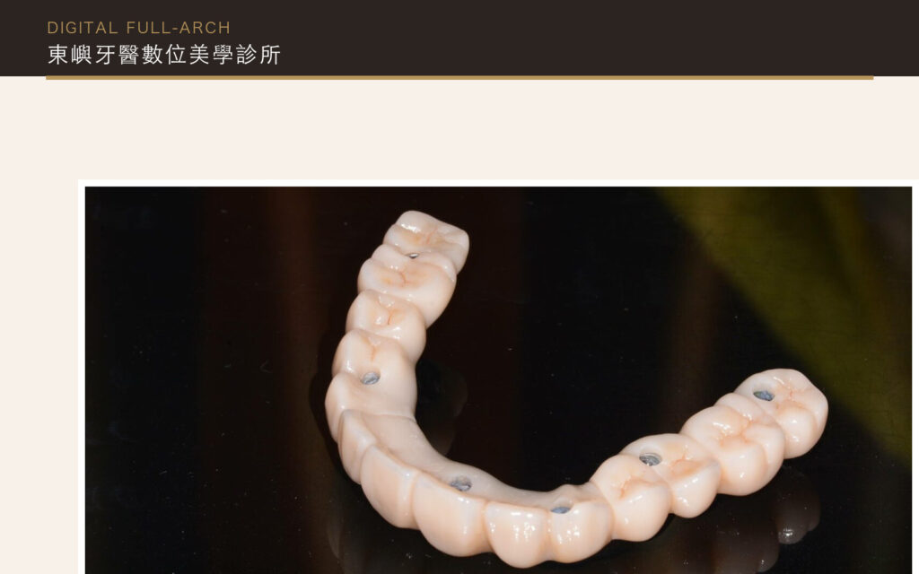 All-on-X 全口重建贋復設計與完成品紀錄｜東嶼牙醫數位美學診所