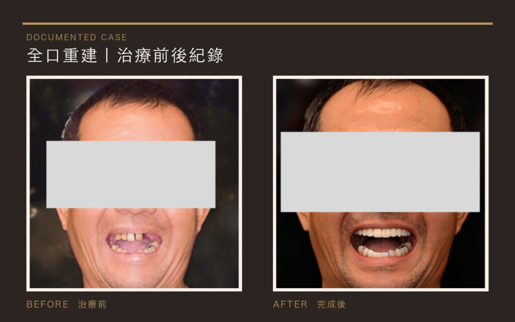All-on-X 全口重建治療前後紀錄｜東嶼牙醫數位美學診所
