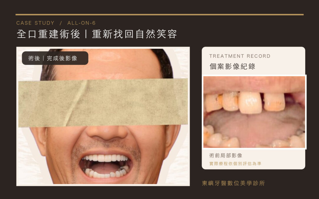 All-on-6 全口重建術後完成影像與術前局部影像｜東嶼牙醫數位美學診所