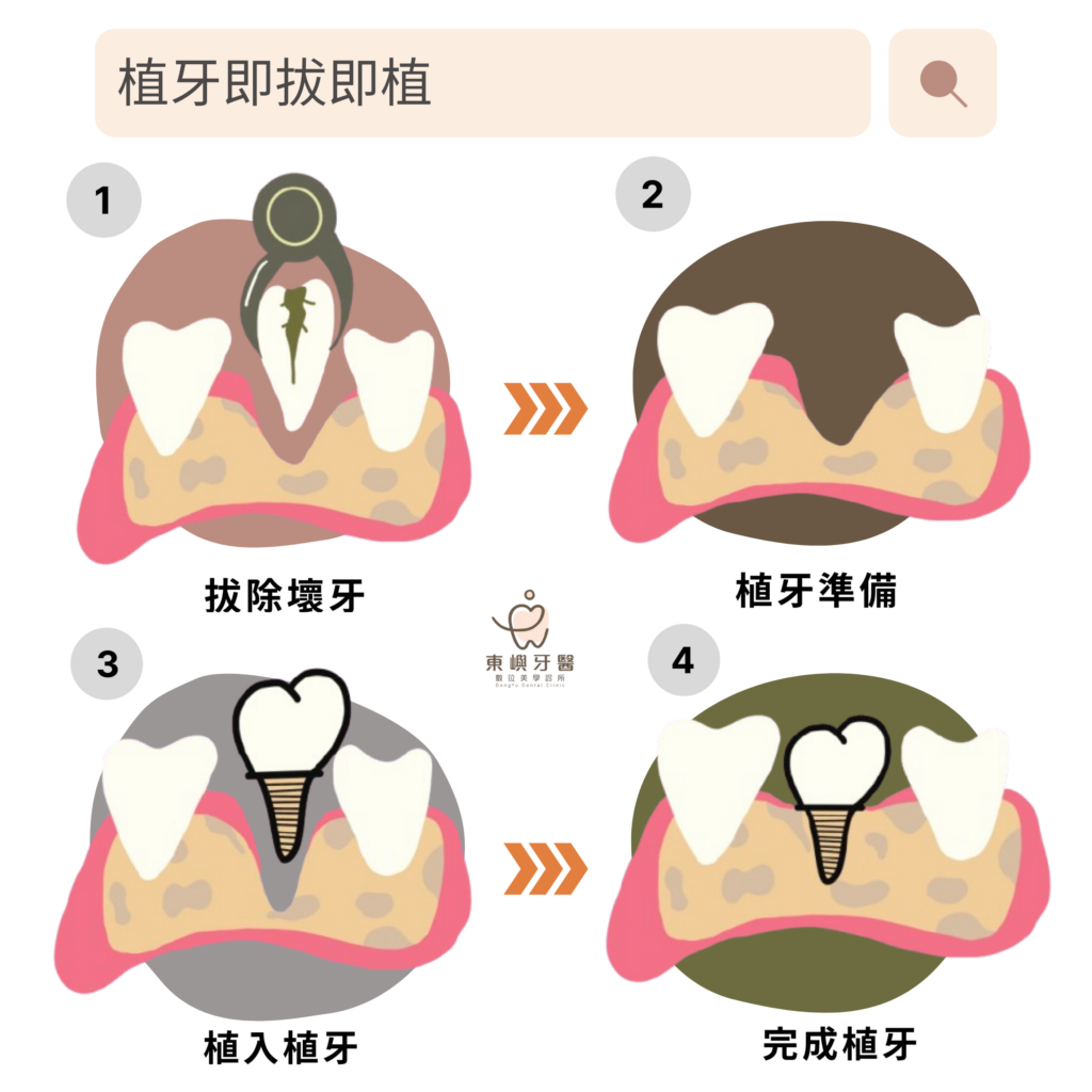 即拔即植流程