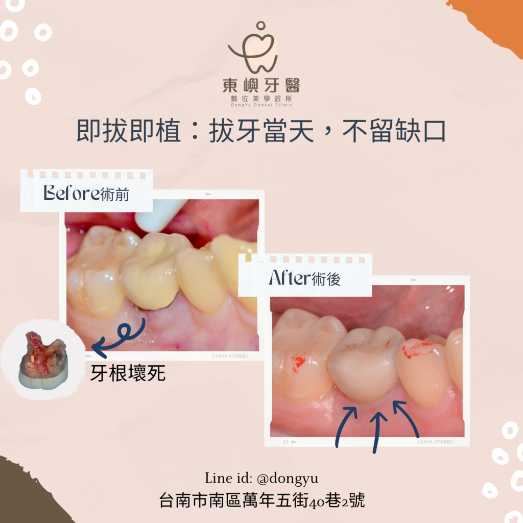 即拔即植案例分享