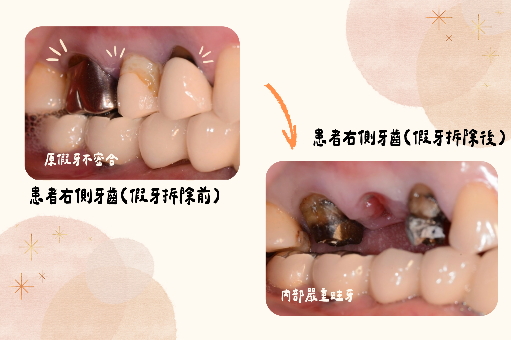 拆除舊牙橋後檢查右側支台齒蛀蝕