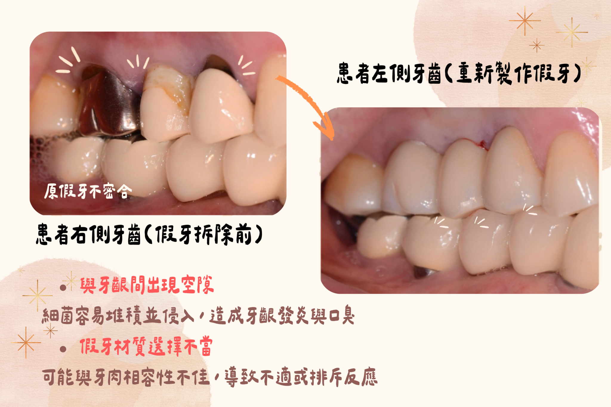 右側支台齒保存與牙橋重建完成