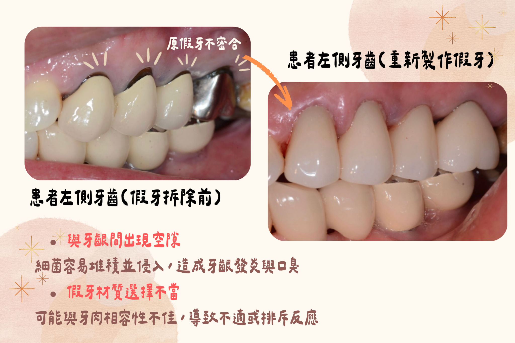 左側支台齒保存與牙橋重建完成