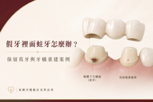 假牙下方蛀牙與牙橋重建案例封面｜東嶼牙醫數位美學診所