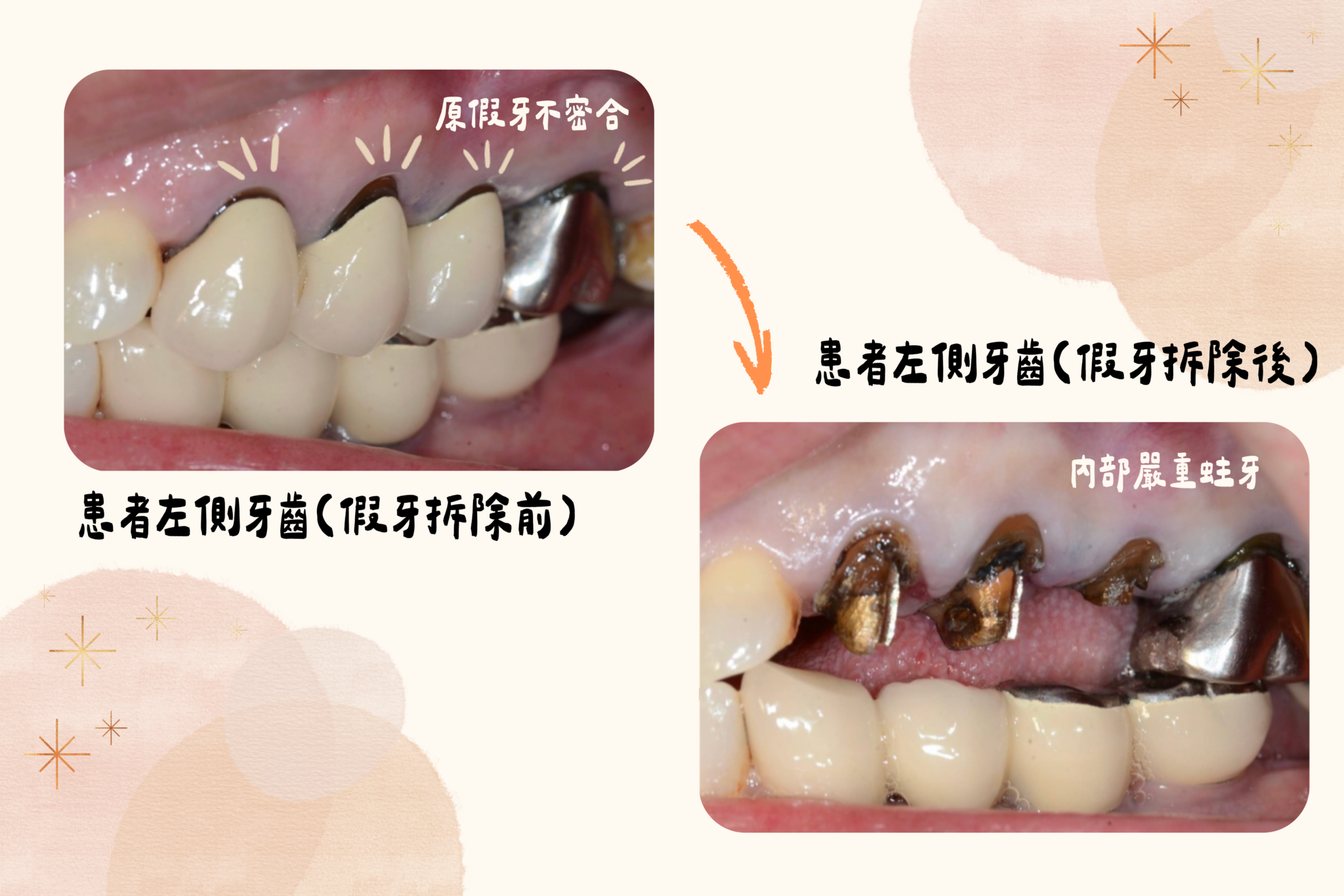 不必拔牙也能重建咬合 左側假牙蛀牙