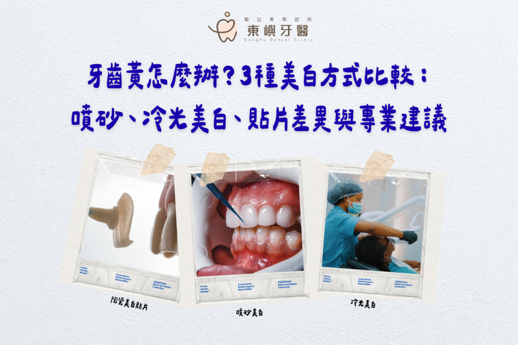 牙齒黃怎麼辦？3種美白方式比較：噴砂、冷光美白、貼片差異與專業建議