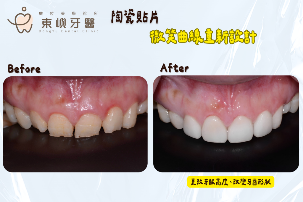 陶瓷美白貼片 東嶼牙醫微笑曲線設計