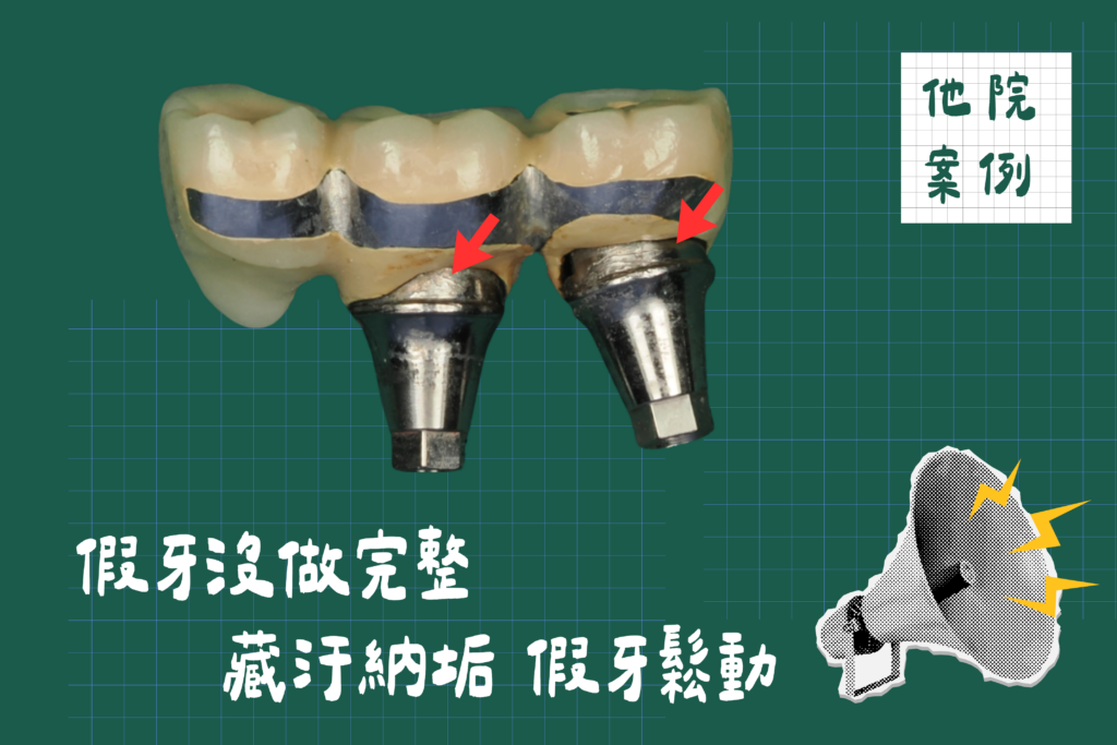 植牙失敗他院案例4
