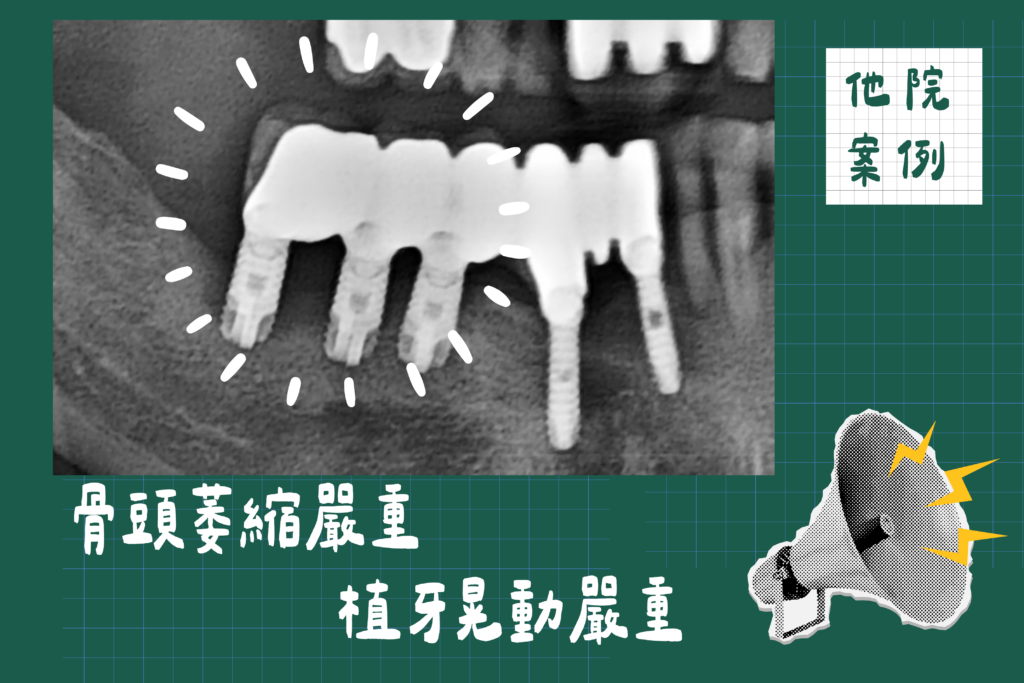 植牙失敗他院案例3