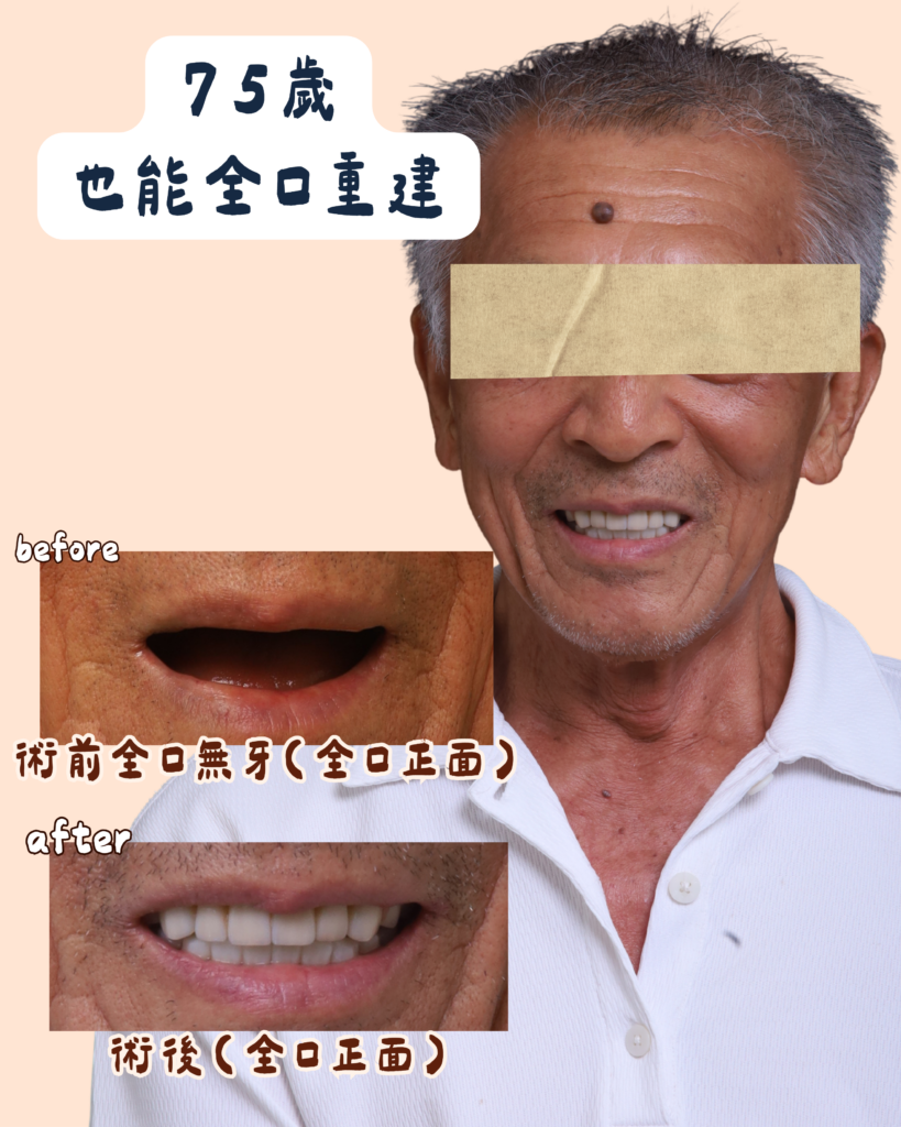 東與高齡植牙Before&after (1)
