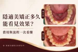 隱適美矯正時間、費用與流程封面｜東嶼牙醫數位美學診所