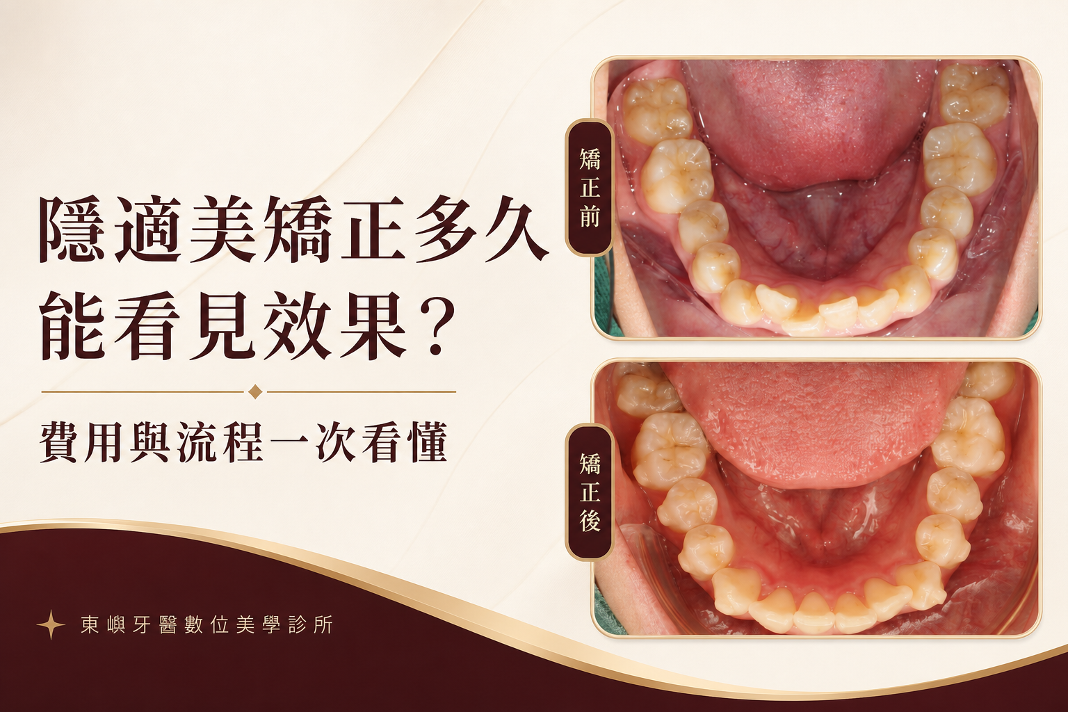 隱適美矯正時間、費用與流程封面｜東嶼牙醫數位美學診所