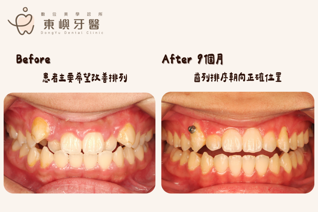 東嶼牙醫 Invisalign 排列咬合與維持案例紀錄
