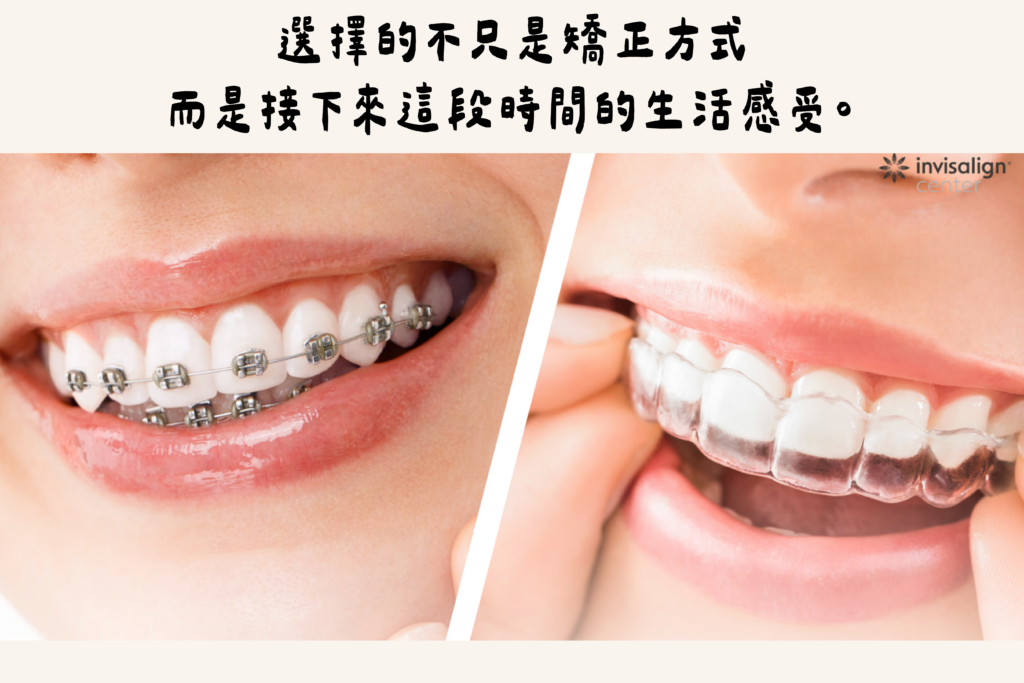 台南東嶼牙醫＿隱適美vs傳統矯正
