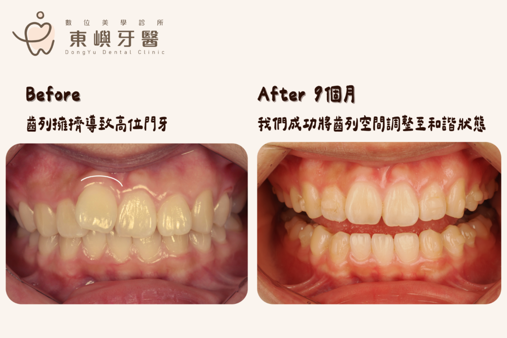 東嶼牙醫矯正患者前後對比照1