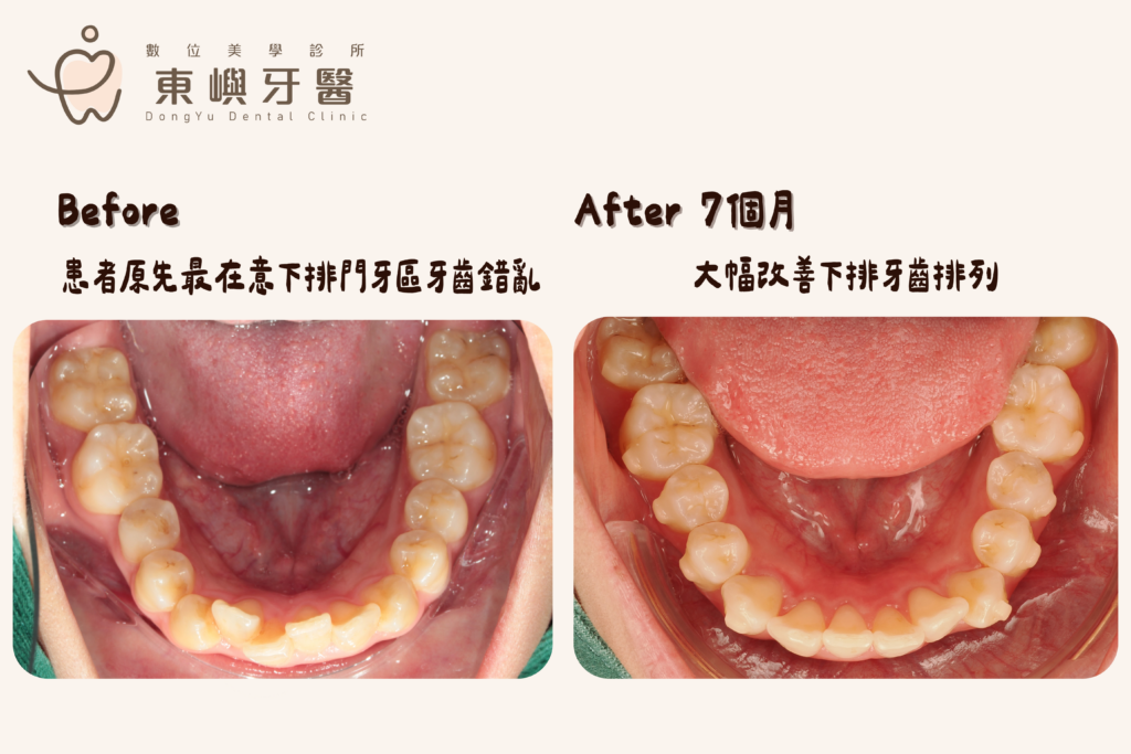 東嶼牙醫矯正患者前後對比照2