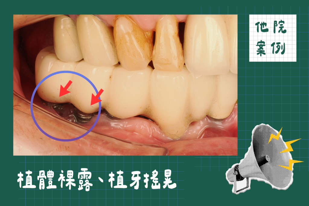 植牙失敗他院案例