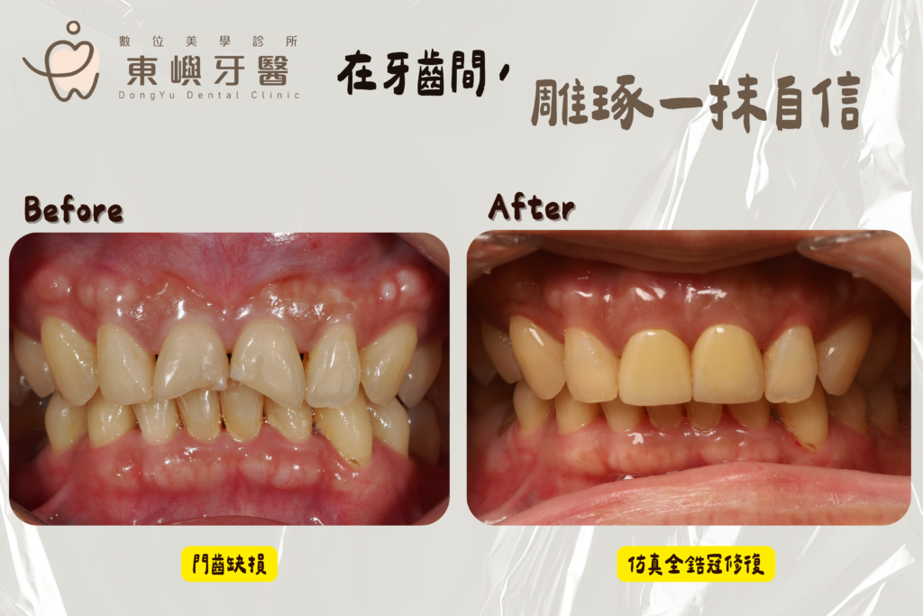 兩顆正中門牙磨損與色澤不均，全鋯冠前牙美學重建治療前後對照