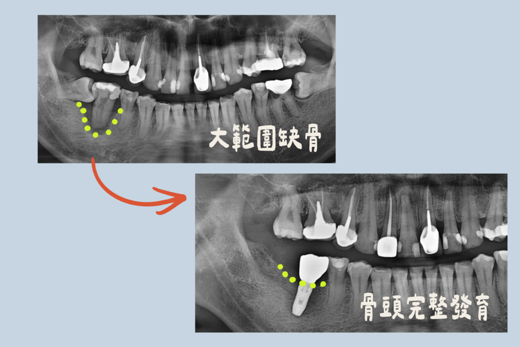 拔牙及 ARP 後齒槽骨條件追蹤影像｜東嶼牙醫