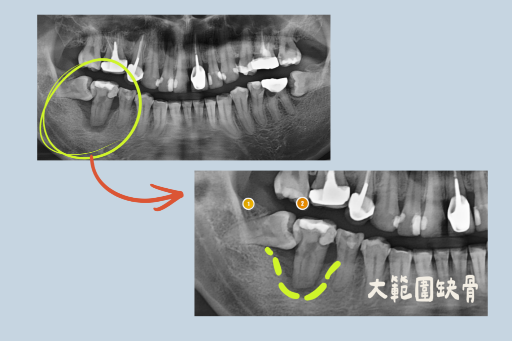 拔牙前第二大臼齒感染與齒槽骨缺損影像｜東嶼牙醫 ARP 案例