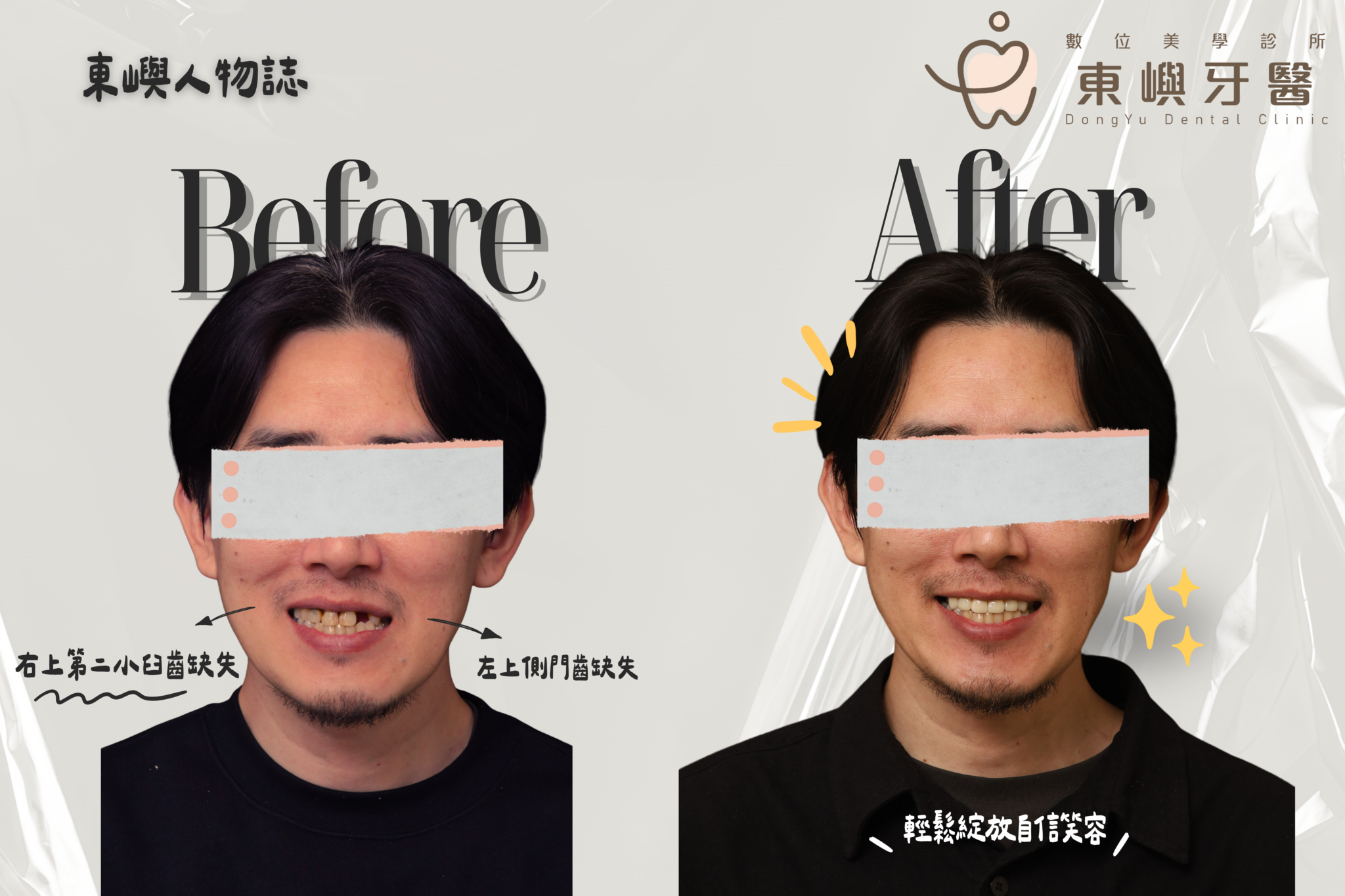 上排牙齒磨耗以牙冠、牙橋與咬合調整完成重建的治療前後比較
