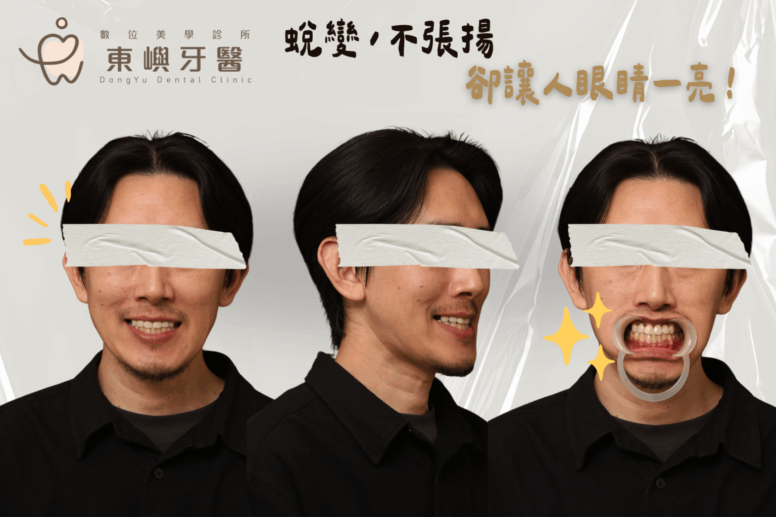 男性完成上排多顆固定式假牙與咬合高度重建後的自然笑容