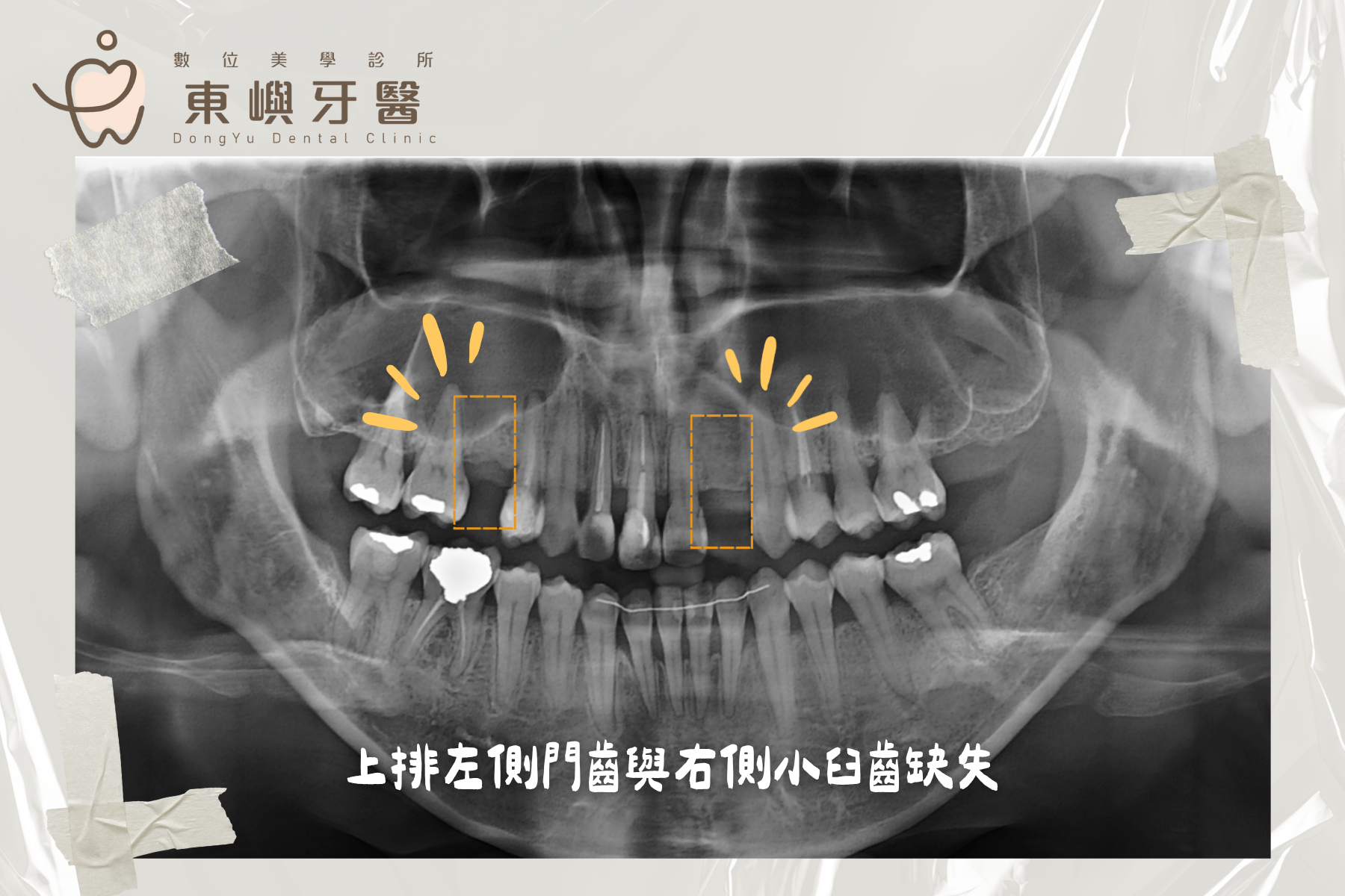 上排多顆牙齒磨耗、缺牙與咬合高度重建前的影像評估