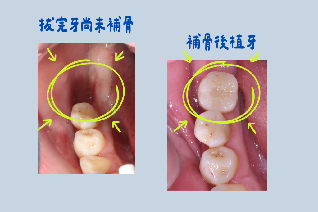 齒槽骨保存術 ARP 後骨頭癒合追蹤影像｜東嶼牙醫