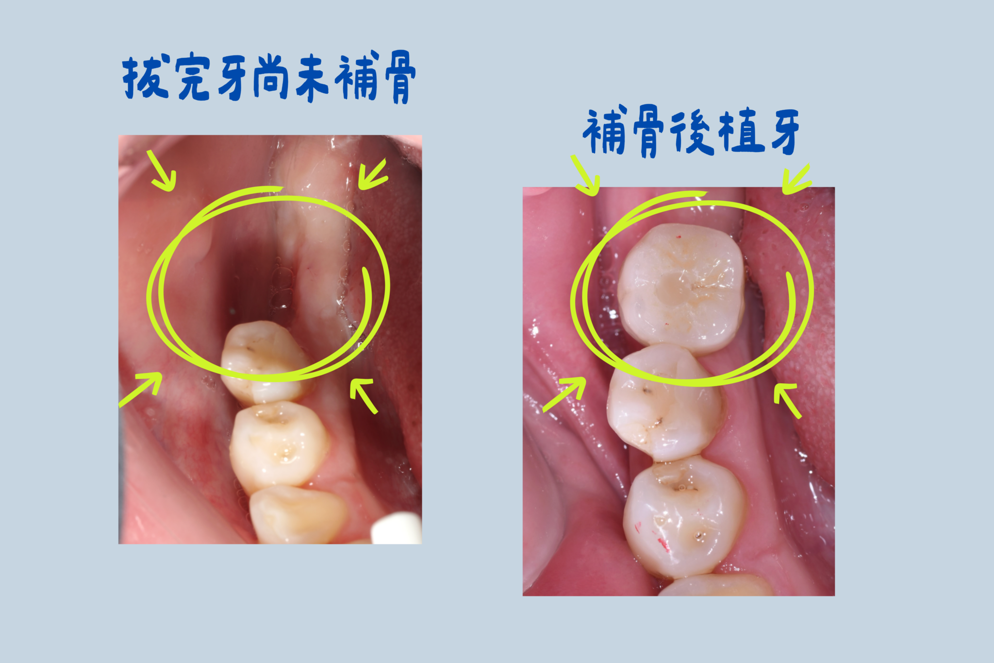 arp骨頭發育｜東嶼牙醫