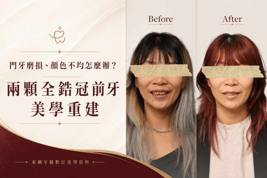 兩顆全鋯冠前牙美學重建案例封面｜東嶼牙醫數位美學診所