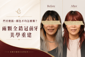 兩顆全鋯冠前牙美學重建案例封面｜東嶼牙醫數位美學診所