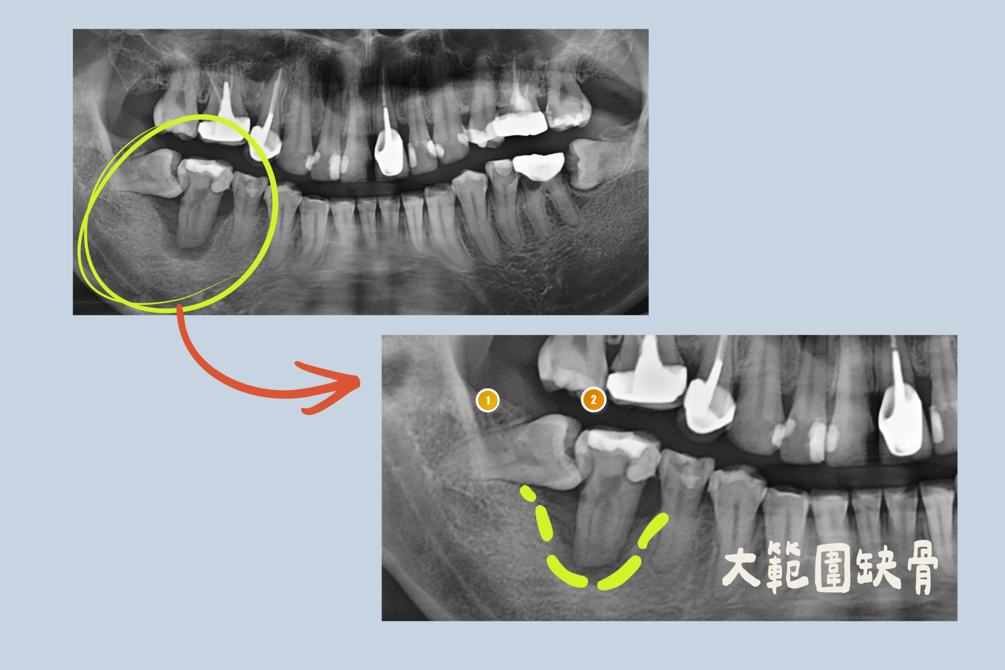 大範圍缺骨arp骨頭發育｜東嶼牙醫