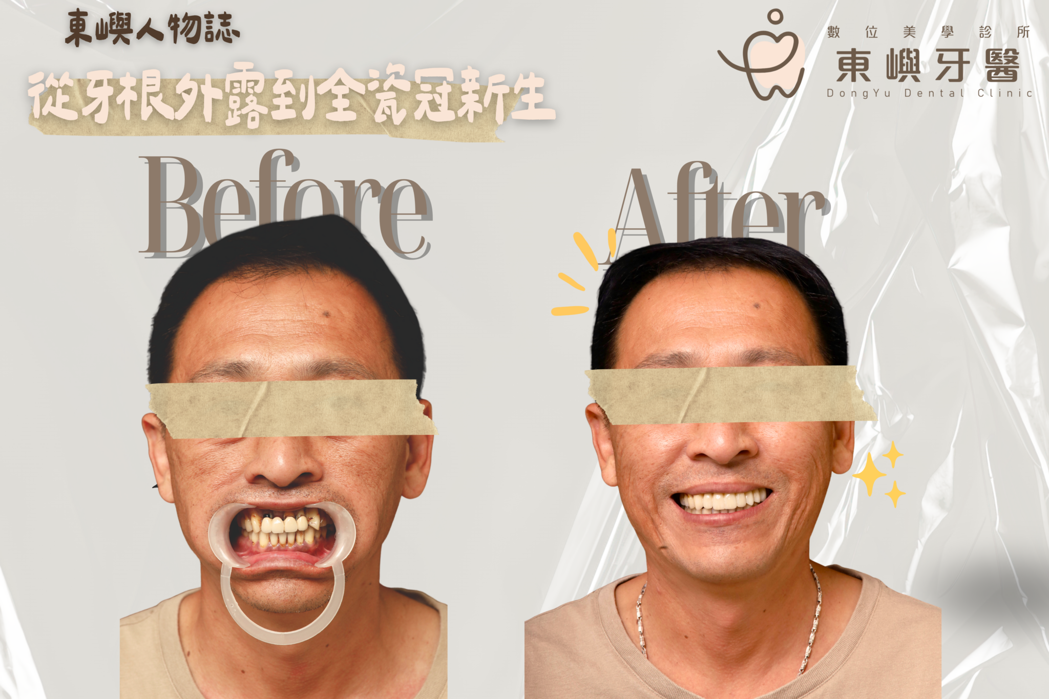 東嶼人物誌 牙周病嚴重案例