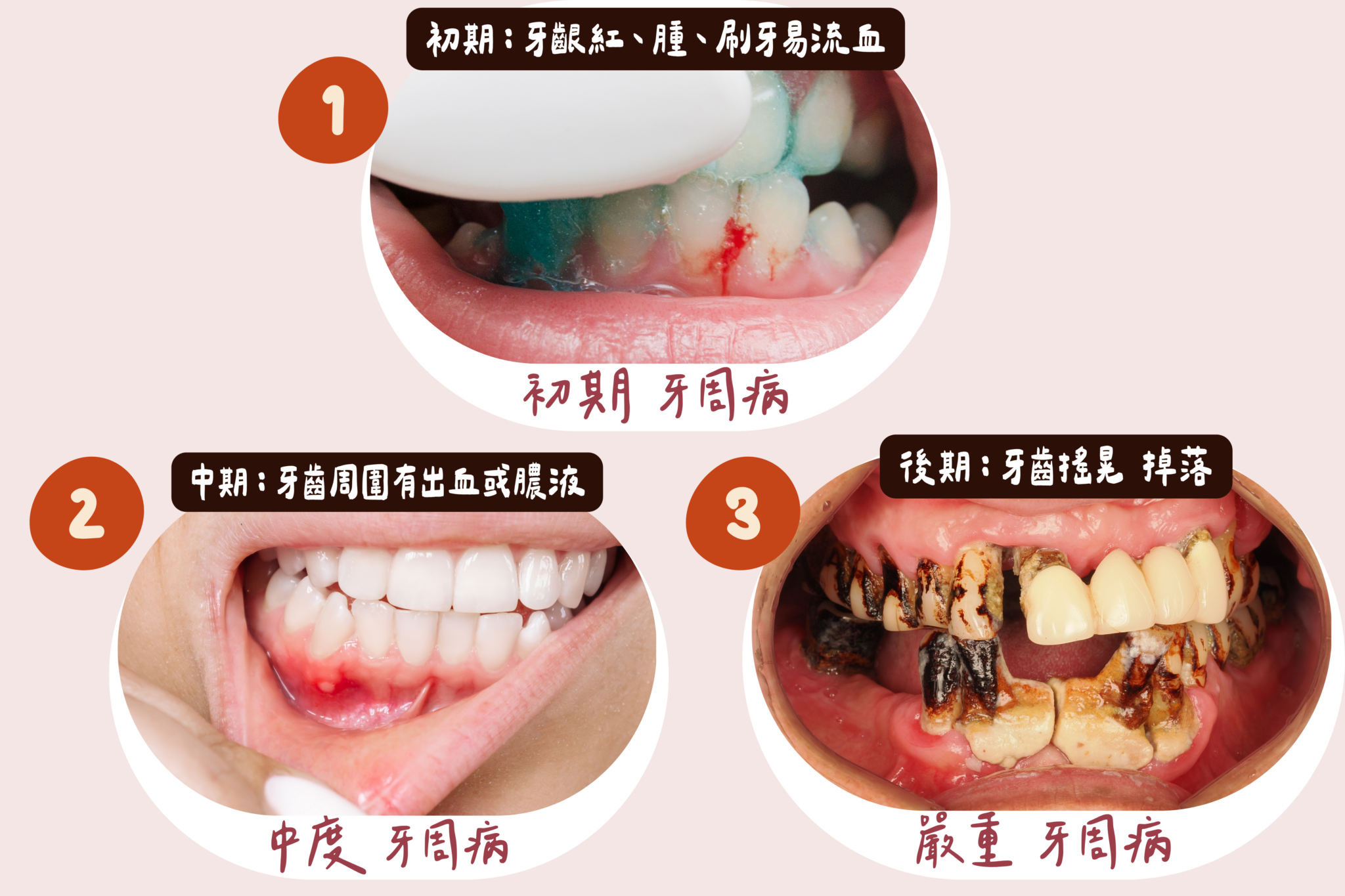 牙周病x3階段圖示