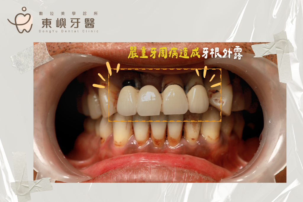 東嶼牙醫牙周病導致牙根外露