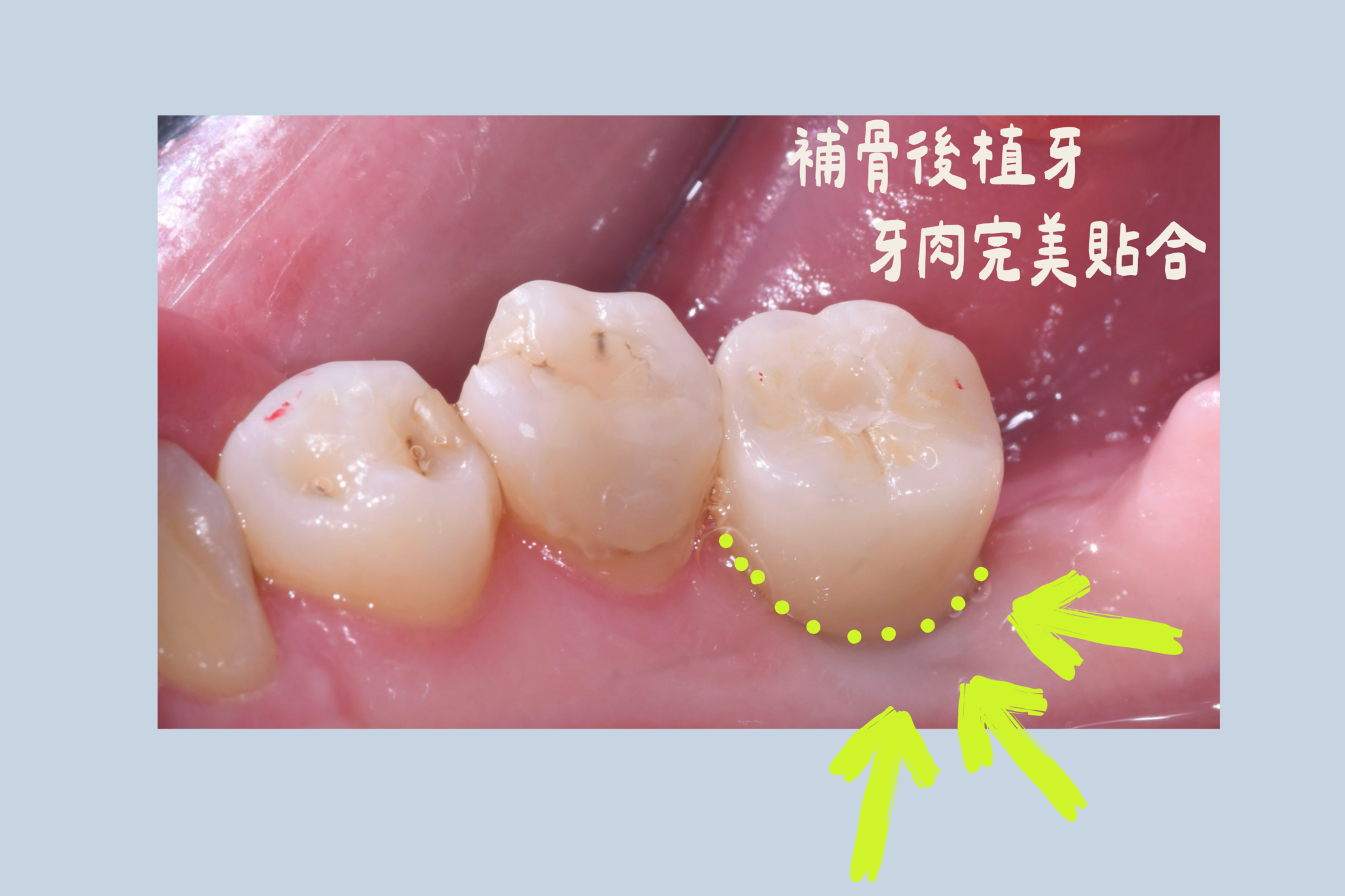 牙肉完美貼合｜東嶼牙醫