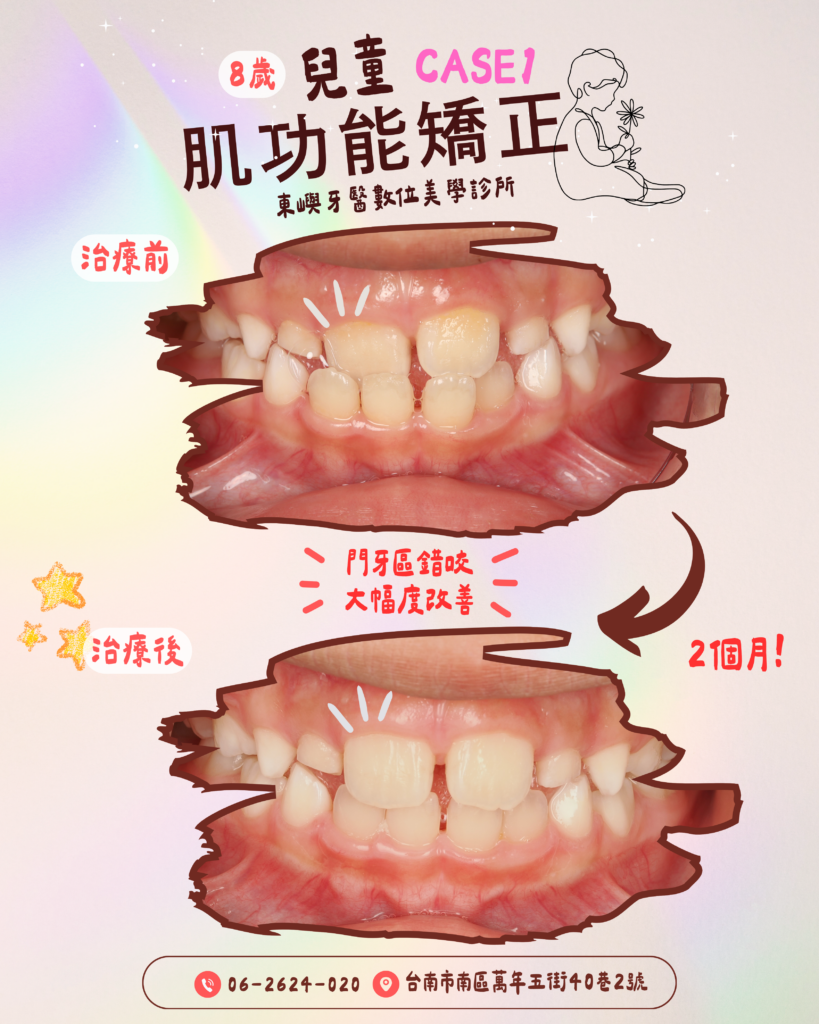 肌功能矯正1 x 東嶼牙醫