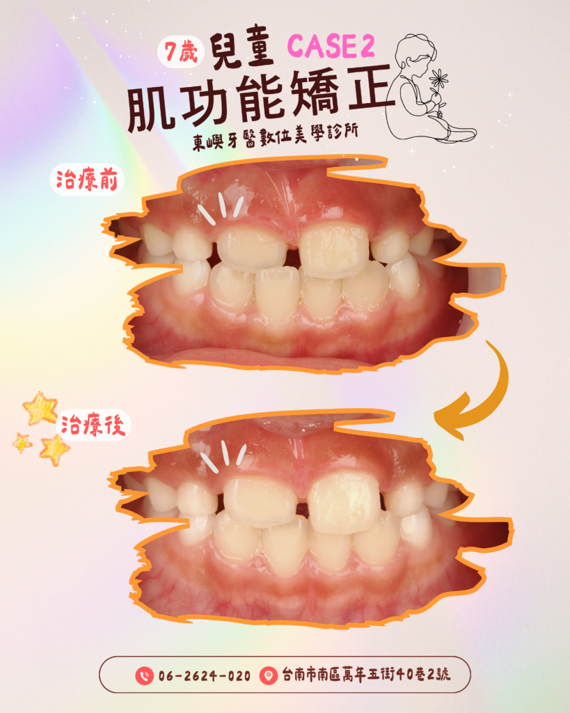 肌功能矯正2 x 東嶼牙醫