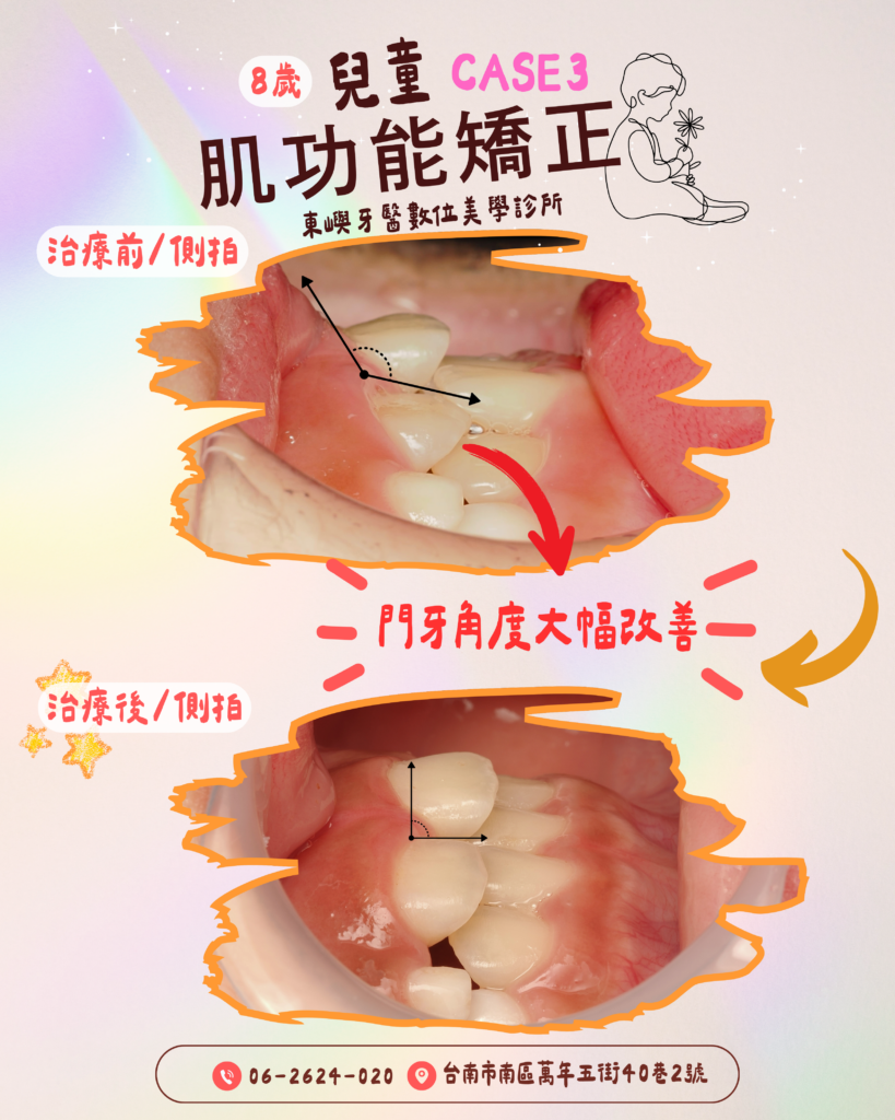 肌功能矯正3 x 東嶼牙醫