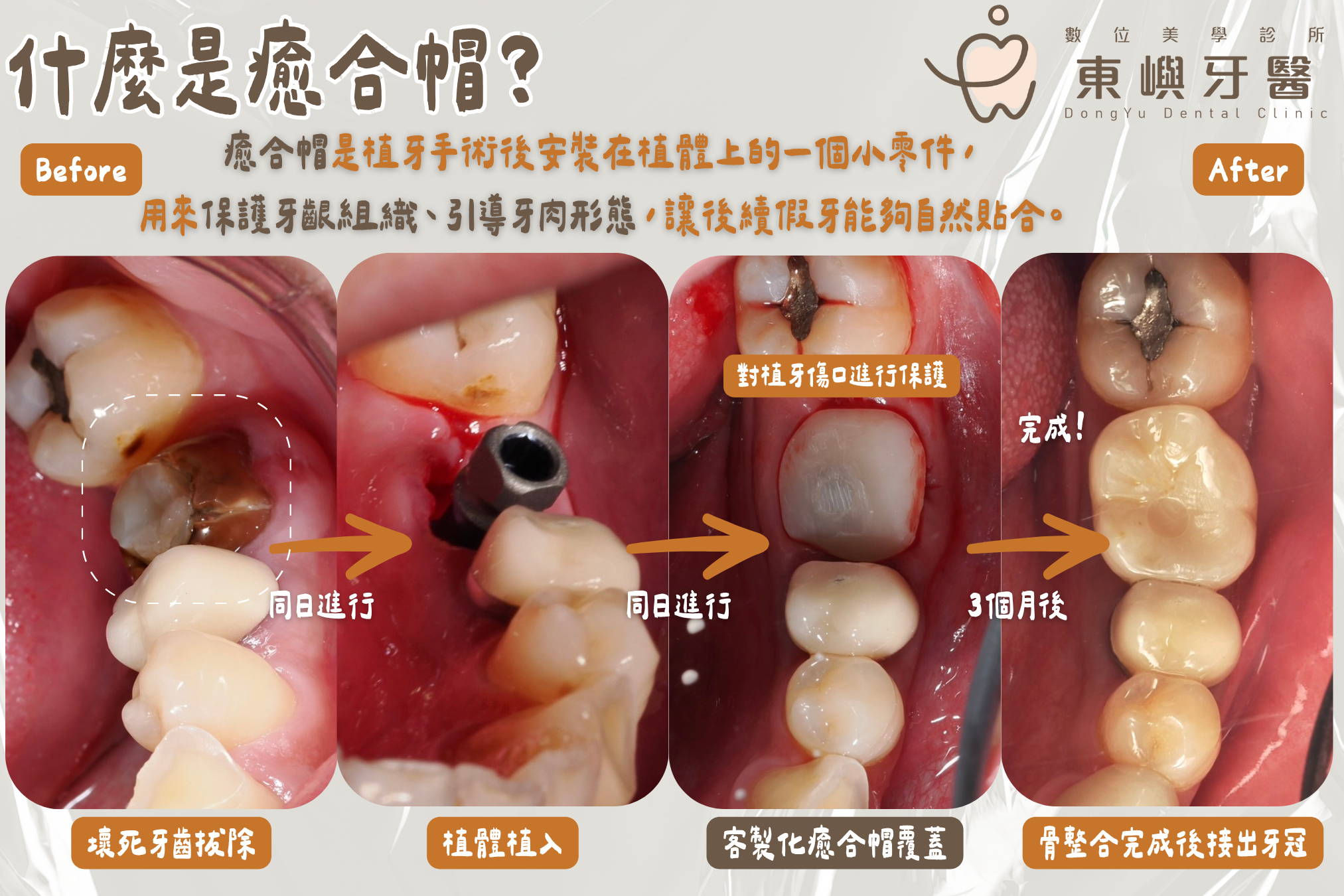 工程師全口重建案例使用的客製化植牙癒合帽