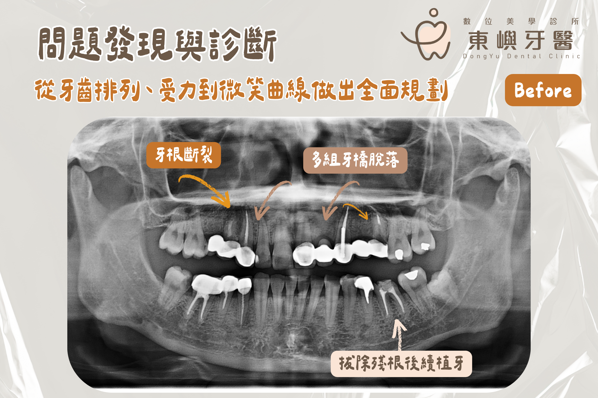 工程師全口重建案例的全口 X 光影像，供醫師評估蛀牙、牙根、缺牙與咬合條件