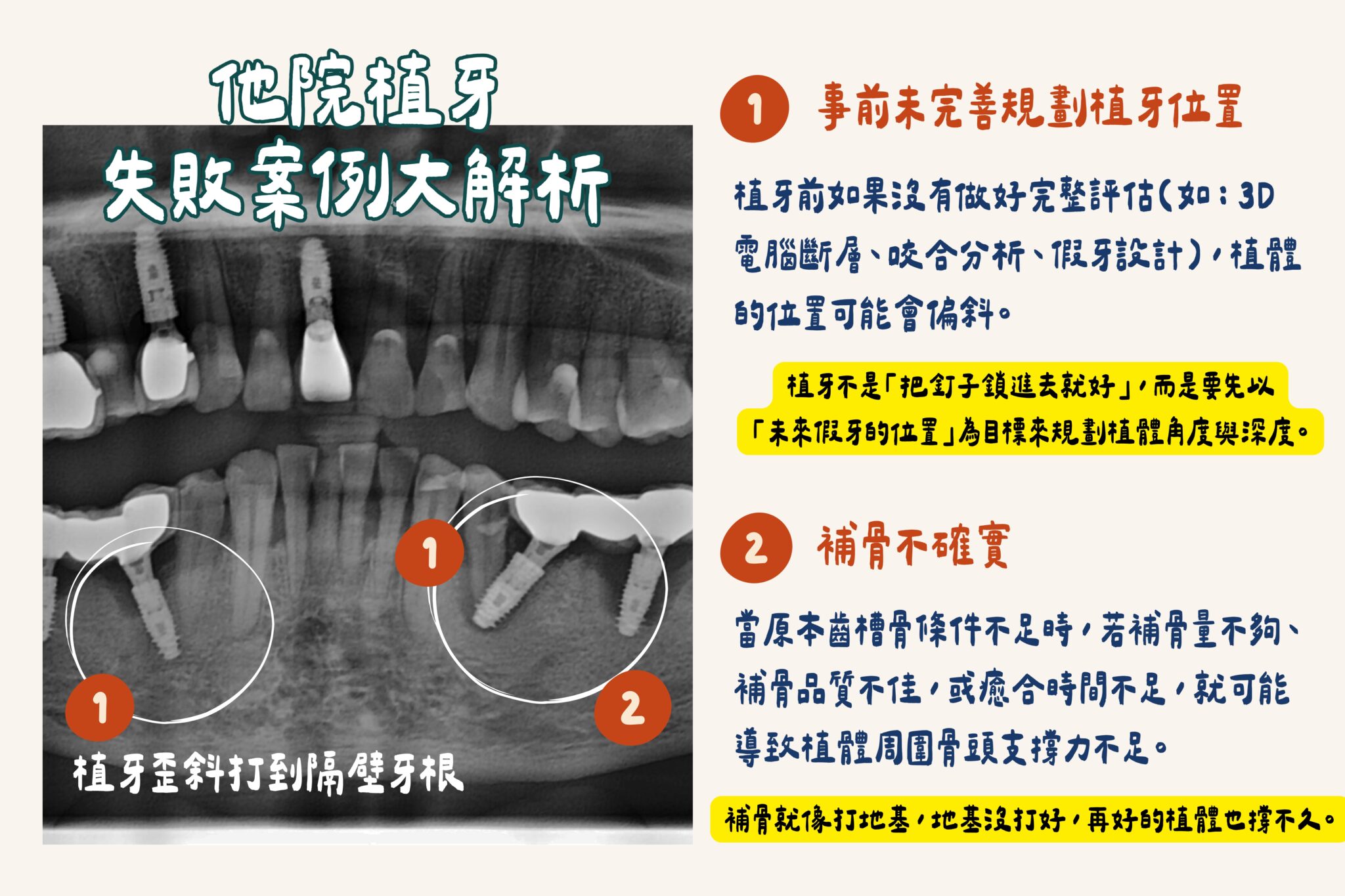 他院植牙 失敗案例大解析