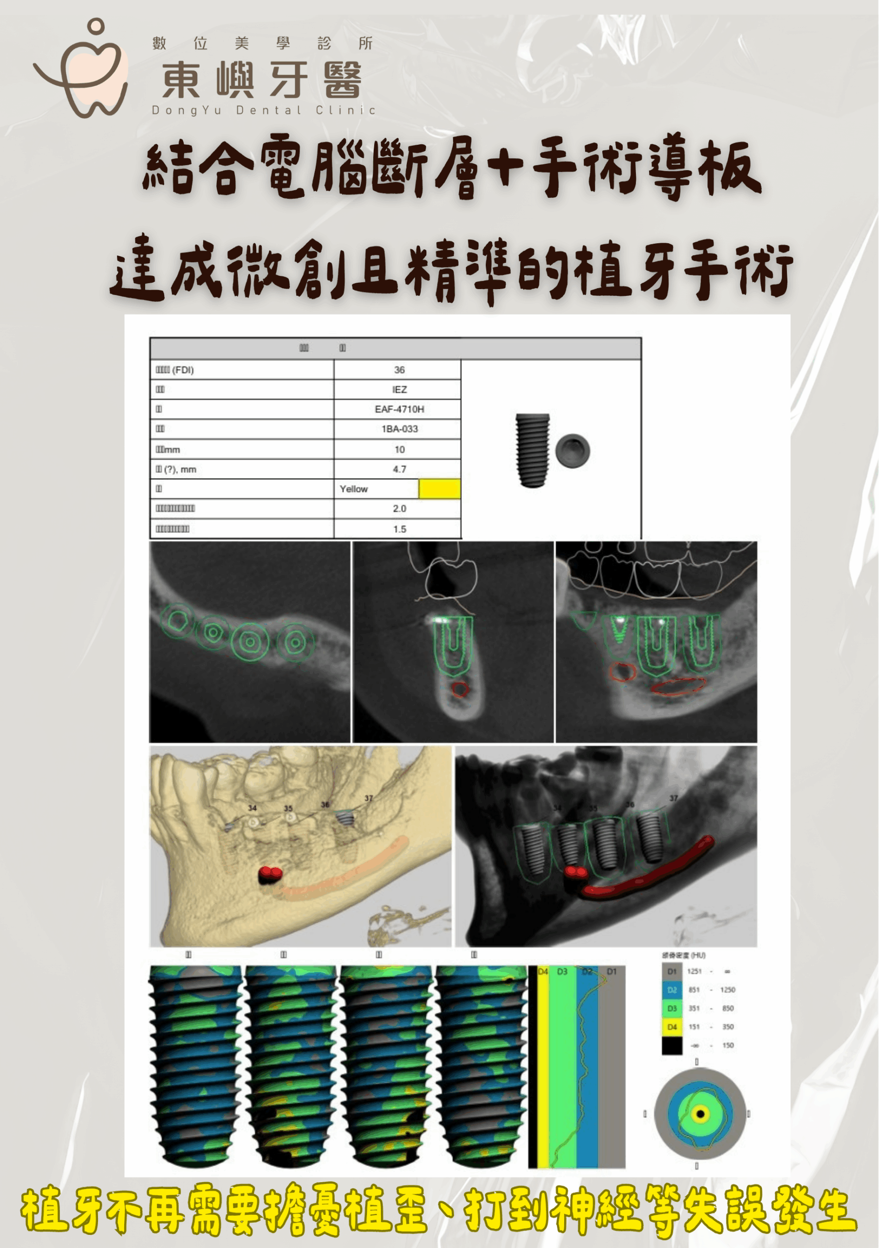 東嶼牙醫植牙術前規劃